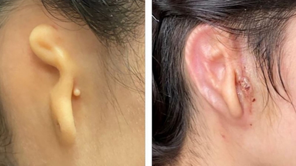 Хирурги пересадили пациенту ухо, выращенное из его собственных клеток