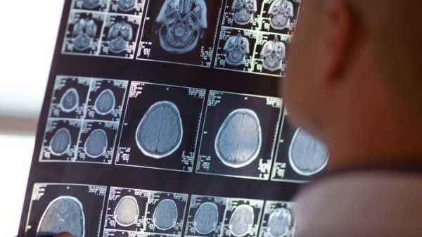 Неизвестное заболевание мозга обнаружили у троих детей